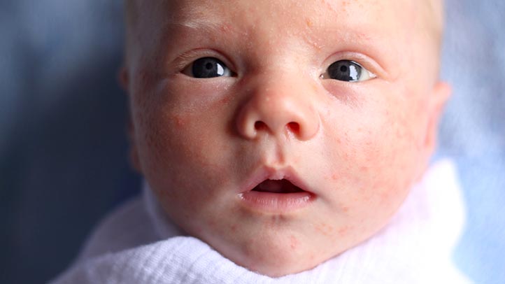 How to Get Rid of Newborn Acne